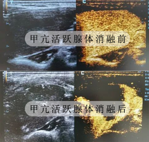 【南京长江甲状腺医院】 治疗甲亢最好的医生排名—— 邵金福