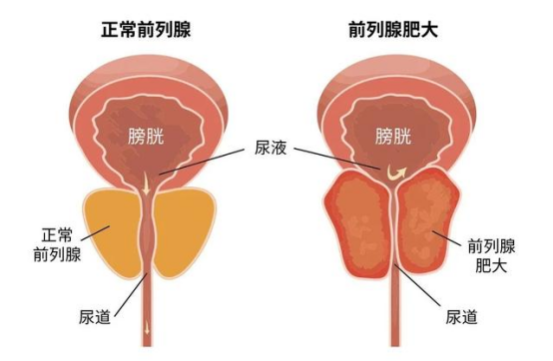 成都川蜀血管病的专家——介入科主任夏正超医生：其实现在只要“一根丝”就可以解决前列腺增生的困难了