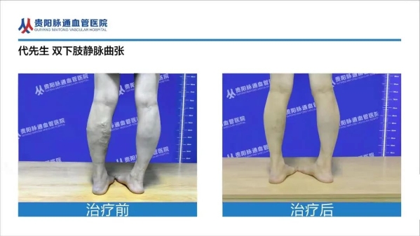 贵阳脉通血管医院口碑好吗？揭秘下肢静脉曲张真相！你离健康只差一步