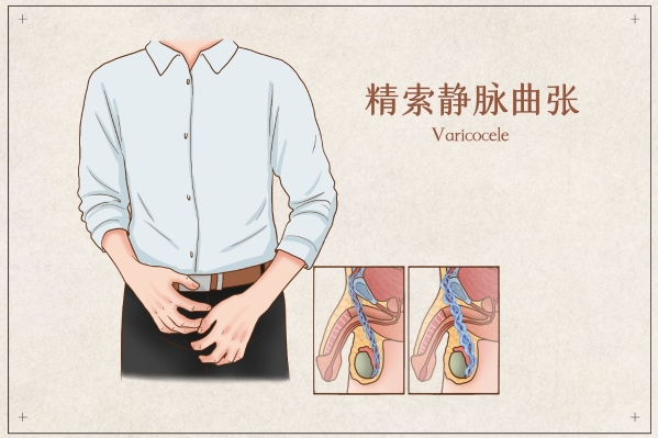 精索静脉曲张手术费用多少钱，在贵阳如何选择靠谱的精索静脉曲张医院