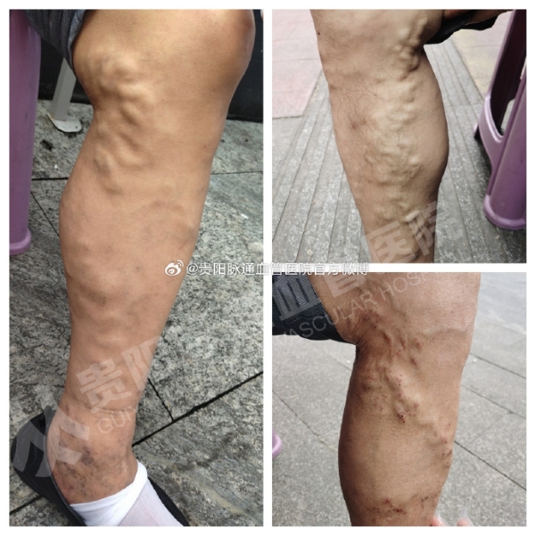 治疗下肢静脉曲张在贵阳要花多少钱？如何选择靠谱的静脉曲张医院