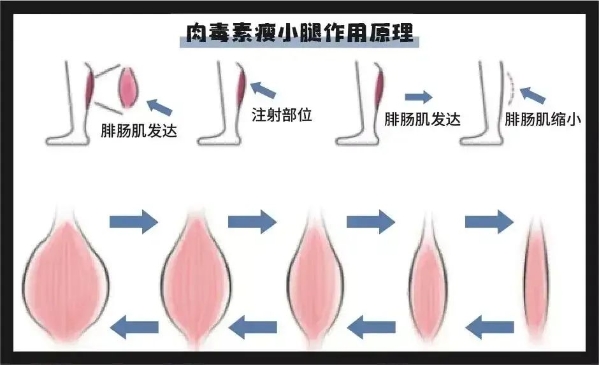 腿型不好看，想改善？试试广州军美王世虎的这些方法吧！