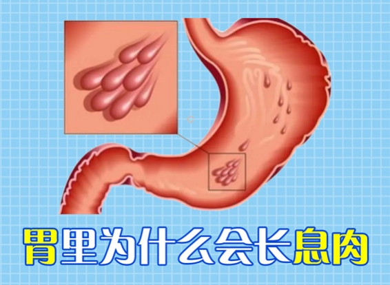 如何预防和控制胃息肉发展？昆明东大肛肠医院：做好七件事